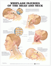 Whiplash Injuries of the Head and Neck