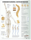 Understanding Osteoporosis